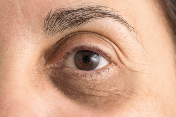 red-eye-treatment-kerala