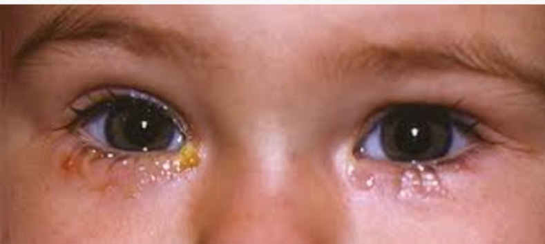 Congenital NLDO