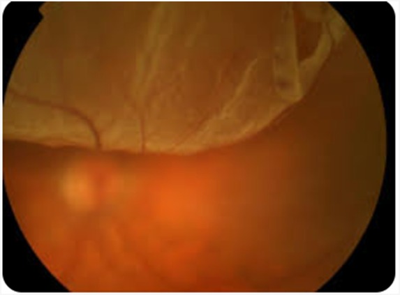 Retinal Detachment