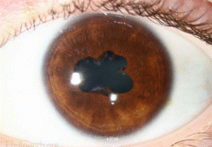 Anterior uveitis
